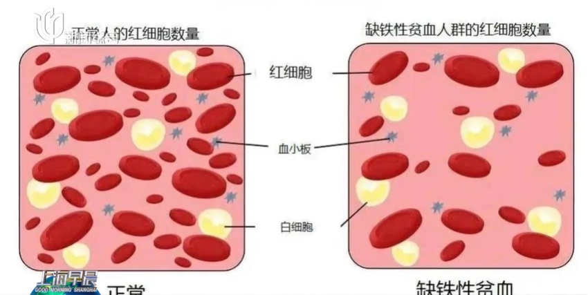 12岁女孩一天喝3杯后被确诊中度贫血！这7类人要注意，医生提醒→
