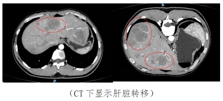 痛心！一家三口先后确诊这种癌！出现这些症状要警惕……