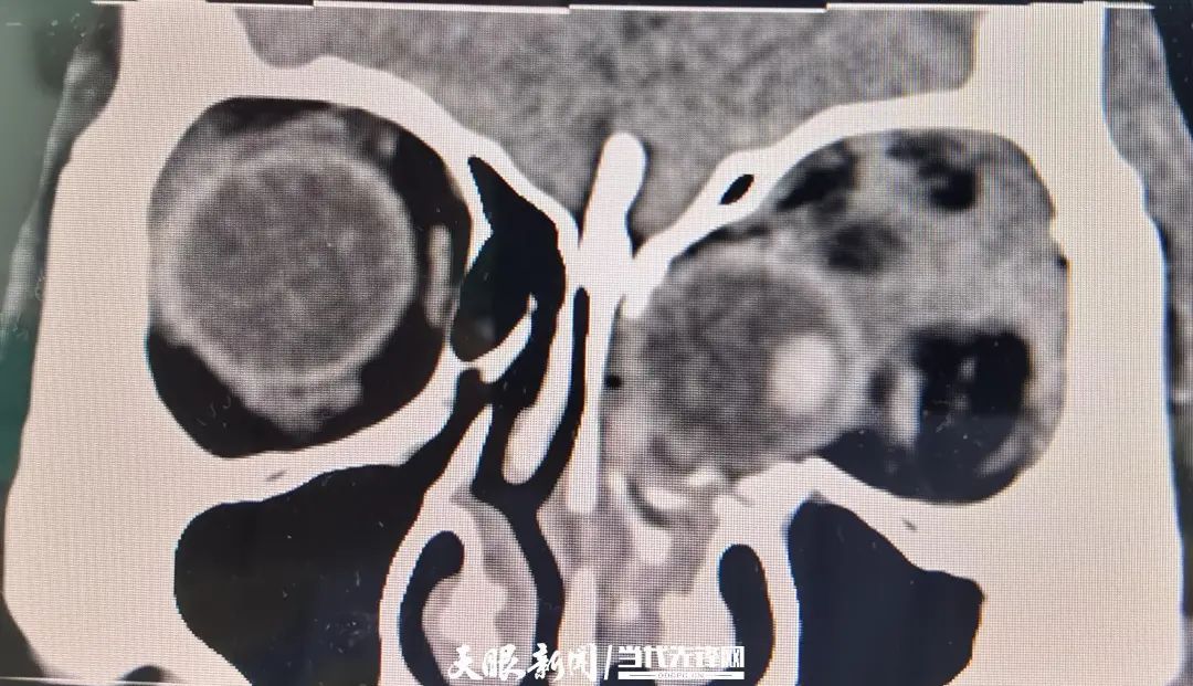 女子不慎坠楼眼球掉进鼻子!贵医附院医生紧急手术…… 女子不慎坠楼眼球掉进鼻子!贵医附院医生紧急手术……