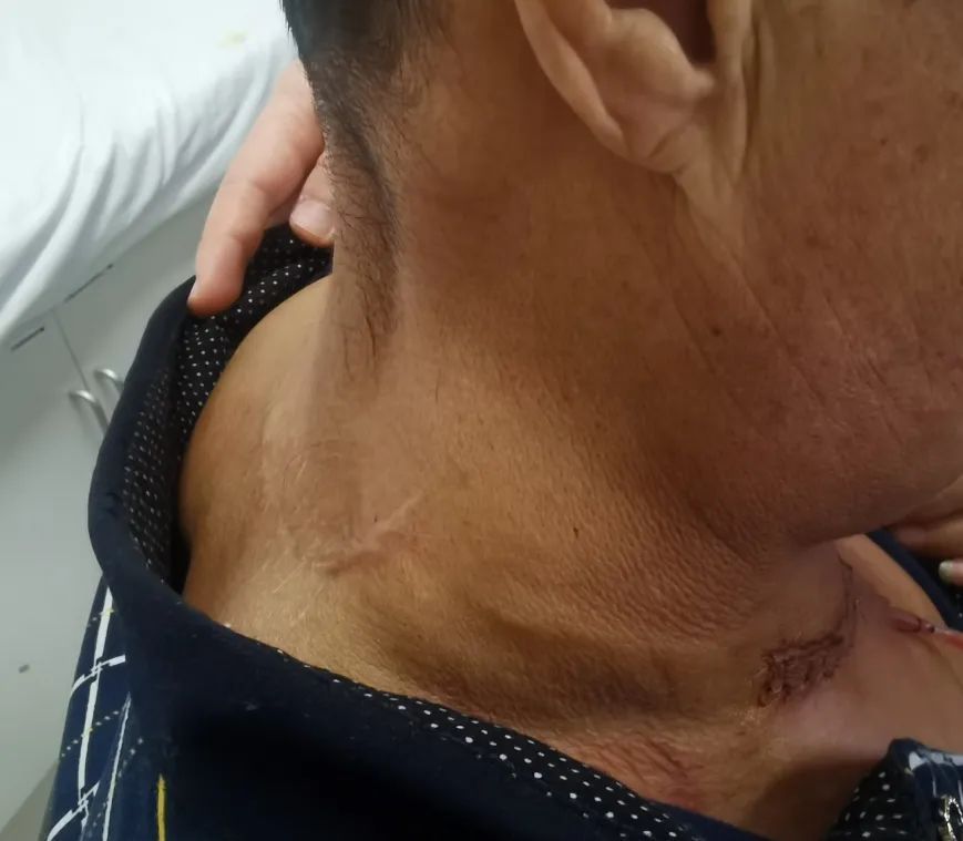 男子自以为魅力十足?老婆嫌弃多年!医生从他的身上割下10斤重.... 男子自以为魅力十足?老婆嫌弃多年!医生从他的身上割下10斤重....