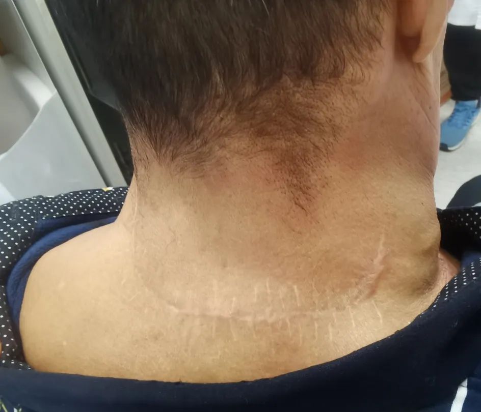 男子自以为魅力十足?老婆嫌弃多年!医生从他的身上割下10斤重.... 男子自以为魅力十足?老婆嫌弃多年!医生从他的身上割下10斤重....