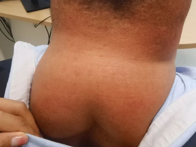 男子自以为魅力十足?老婆嫌弃多年!医生从他的身上割下10斤重.... 男子自以为魅力十足?老婆嫌弃多年!医生从他的身上割下10斤重....