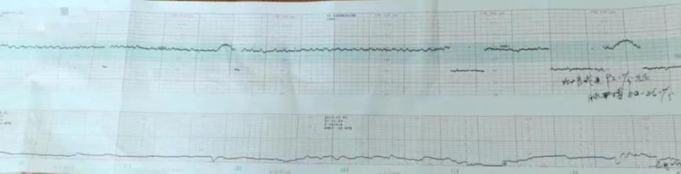 医生从产检结果中发现异常,18分钟紧急娩出胎儿,发现脐带扭转已近40圈! 医生从产检结果中发现异常,18分钟紧急娩出胎儿,发现脐带扭转已近40圈!