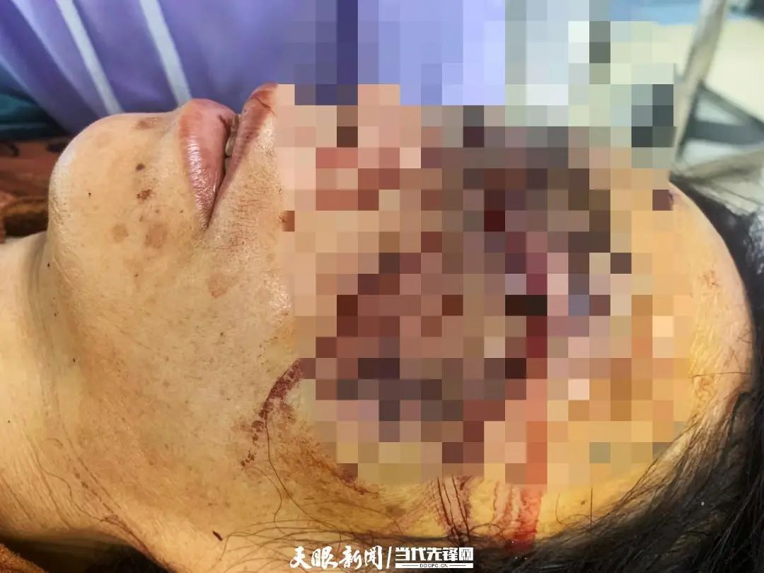 女子不慎坠楼眼球掉进鼻子!贵医附院医生紧急手术…… 女子不慎坠楼眼球掉进鼻子!贵医附院医生紧急手术……