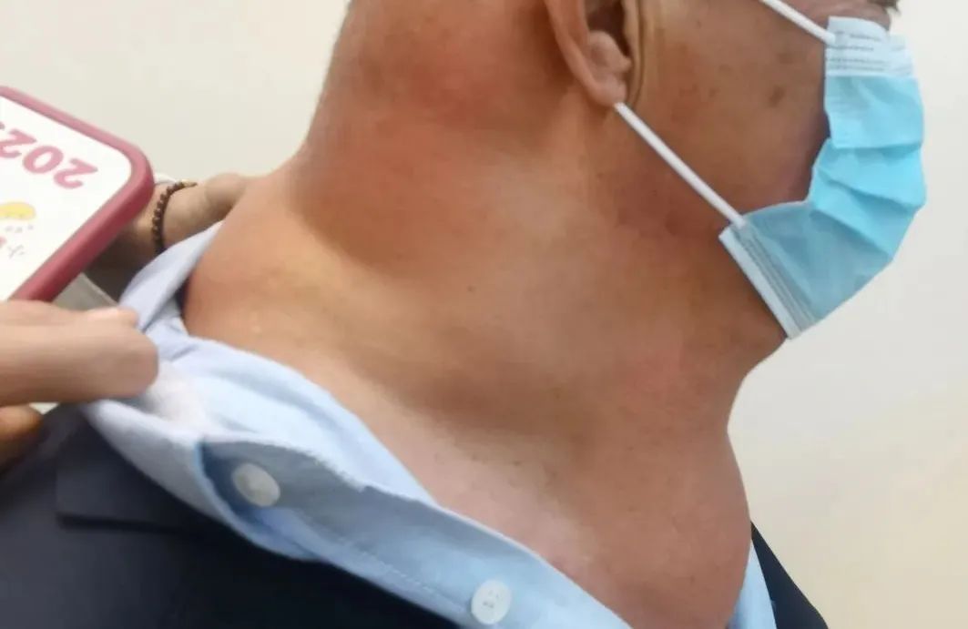 男子自以为魅力十足?老婆嫌弃多年!医生从他的身上割下10斤重.... 男子自以为魅力十足?老婆嫌弃多年!医生从他的身上割下10斤重....