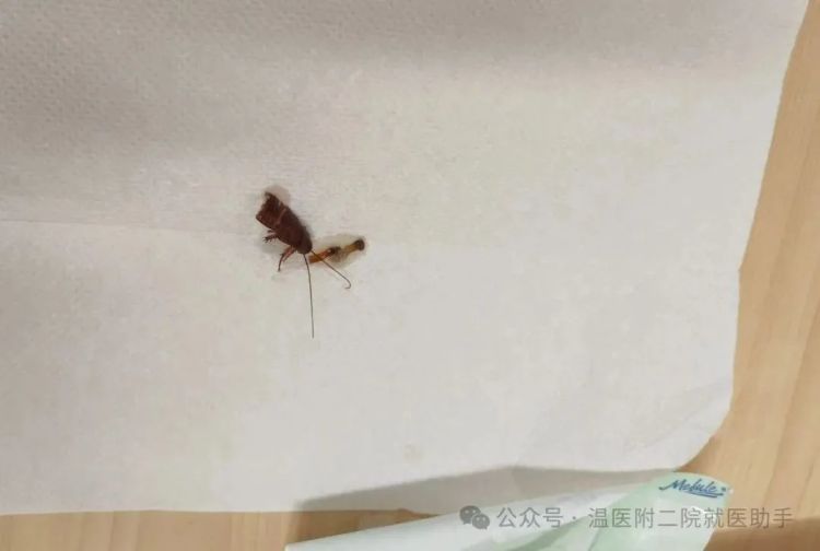 一女子耳鸣就医取出活蟑螂！这种习惯很多人都有