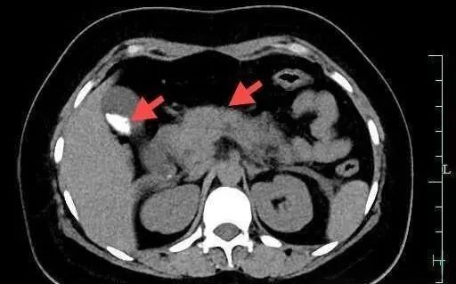 一次狂“炫”四只，女子连夜抢救，严重或致死！医生提醒