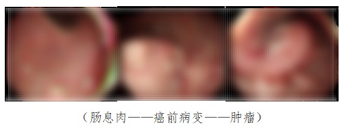 一家三口先后患肠癌，曾错失数次机会…医生：很痛心