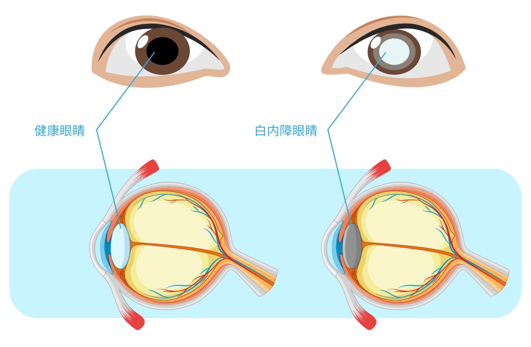 白内障“盯上”年轻人?你中招的风险有多大?赶快跟着专家自检 白内障“盯上”年轻人?你中招的风险有多大?赶快跟着专家自检