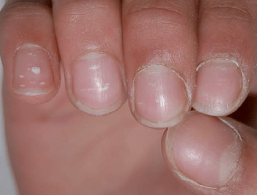 指甲上出现小白点真的是缺钙吗？真要担心的指甲是这样的……