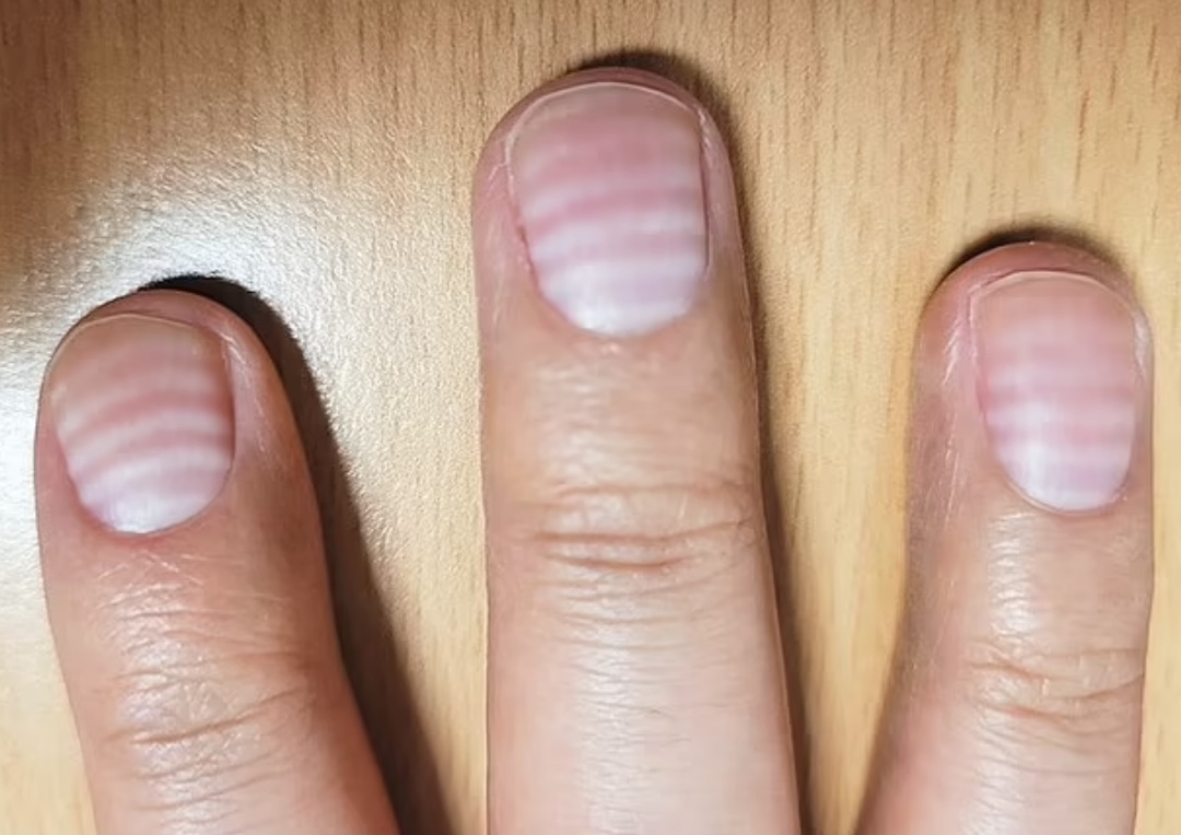 指甲上出现小白点真的是缺钙吗？真要担心的指甲是这样的……