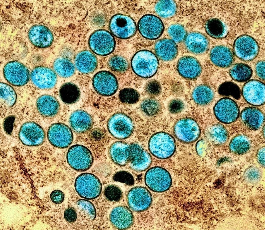 英国猴痘病例增至4例 非洲以外首现集群感染 英国猴痘病例增至4例 非洲以外首现集群感染