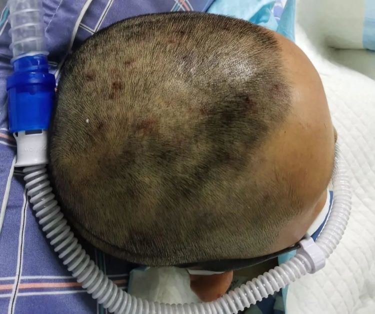 女子爬山被马蜂叮咬引发多器官衰竭,医生提醒 女子爬山被马蜂叮咬引发多器官衰竭,医生提醒