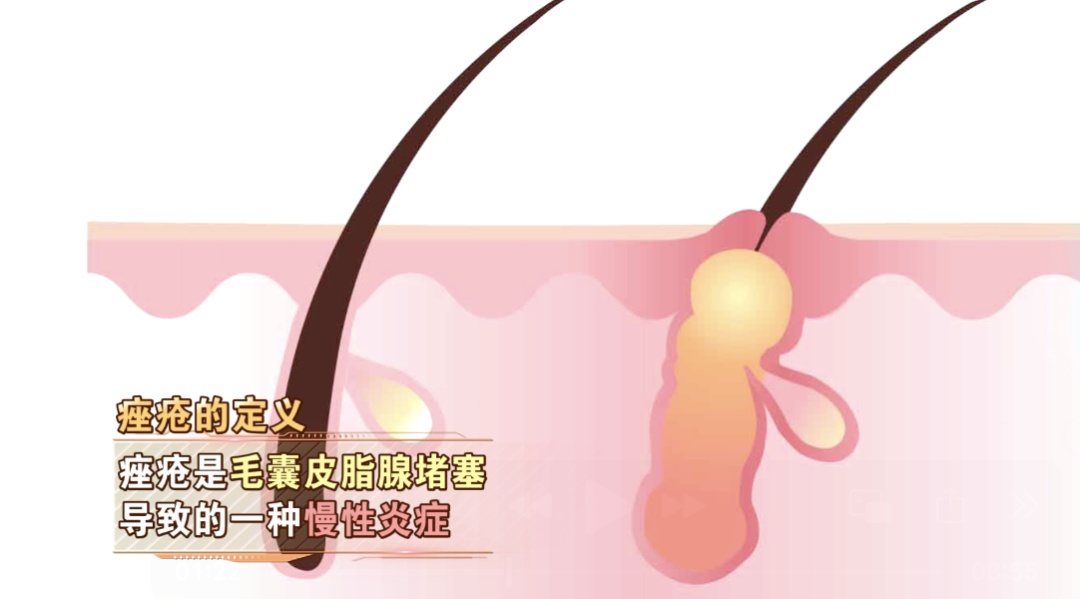 秋天皮肤干燥还容易长痤疮?这也许是你中「毒」了! 秋天皮肤干燥还容易长痤疮?这也许是你中「毒」了!