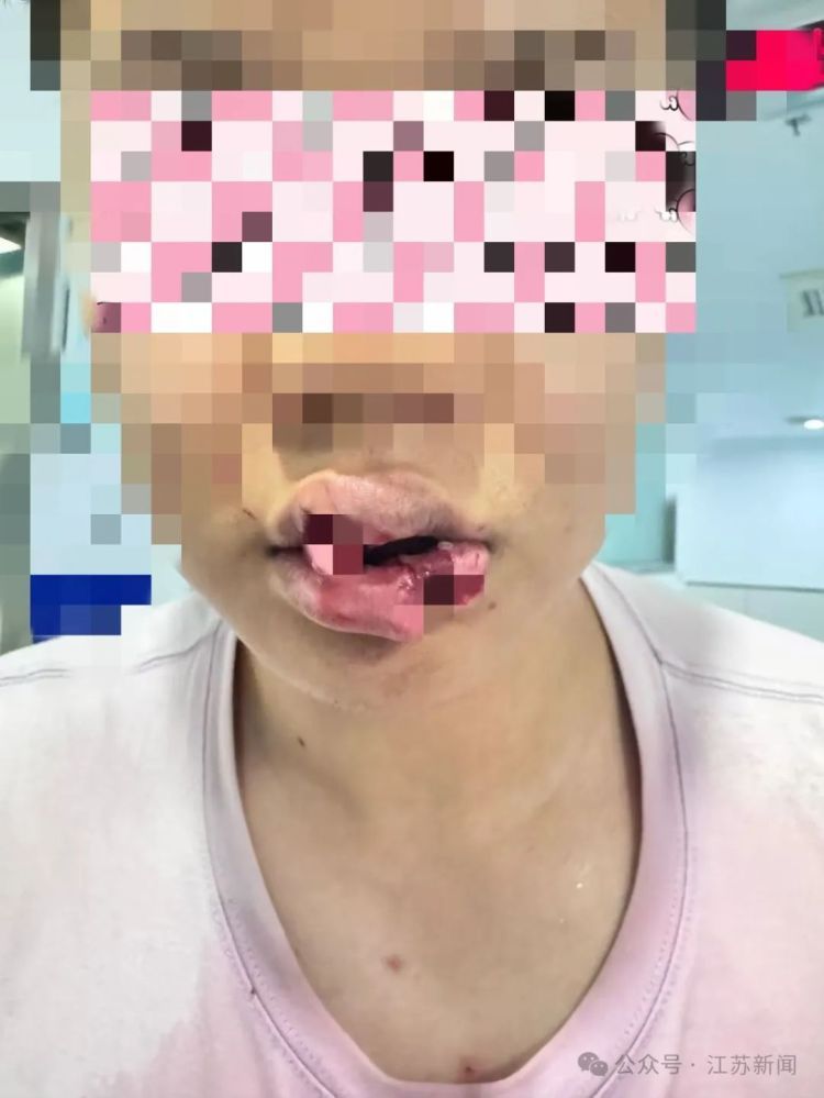 疼!疼!疼!男子与爱宠亲亲被咬下半个嘴唇! 疼!疼!疼!男子与爱宠亲亲被咬下半个嘴唇!