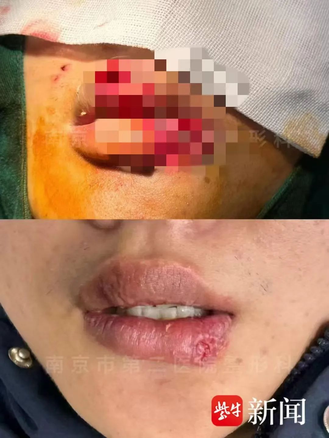 吓人！男子与爱宠“亲亲”，半个嘴唇被咬掉！