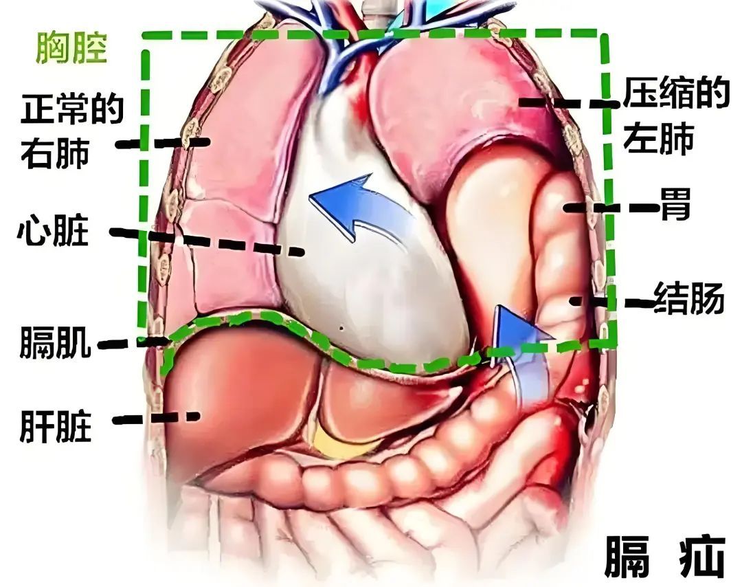 内脏也会“跑路”？男子体检结果震惊医生，肠胃跑到胸腔...