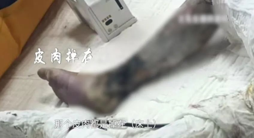 11岁男孩爬火车头遭高压电击！父母崩溃......