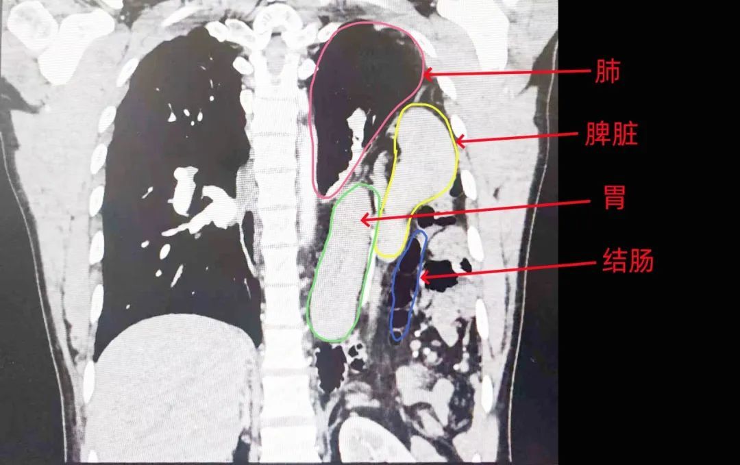 内脏也会“跑路”？男子体检结果震惊医生，肠胃跑到胸腔...