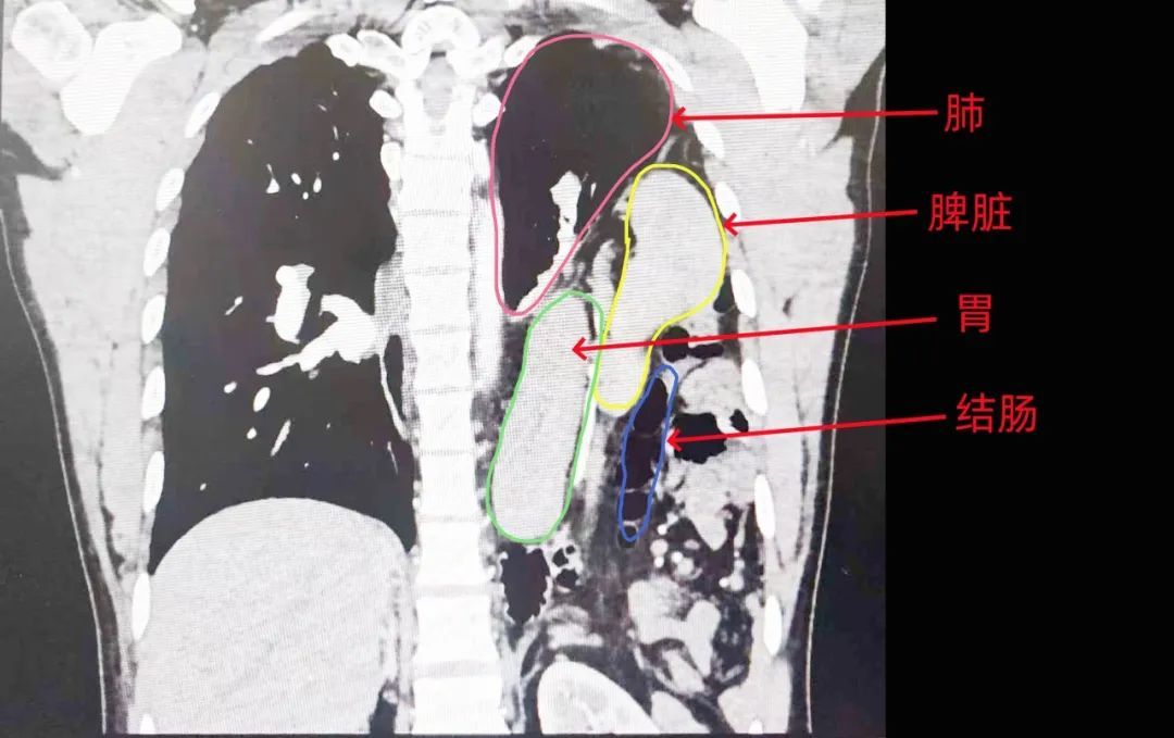 离奇！男子肠胃乱入胸腔十余年，医生提醒：这种情况一定要定期复查