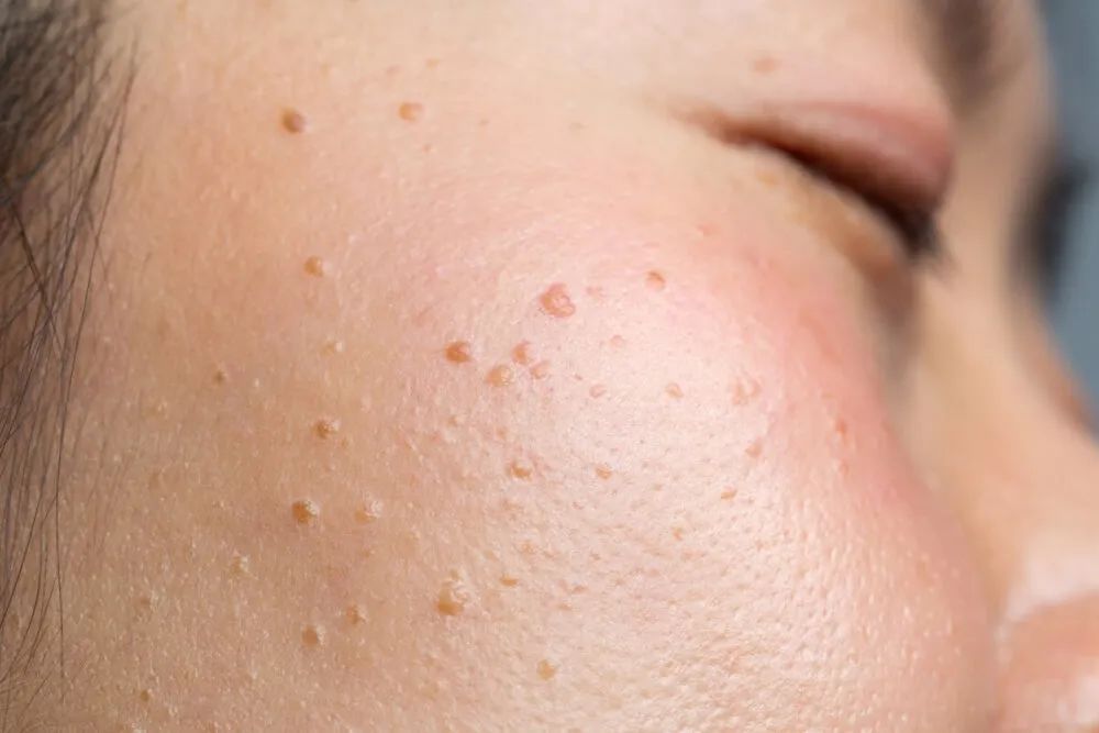 眼睛周围长得这些小颗粒,到底是什么啊啊啊啊? 眼睛周围长得这些小颗粒,到底是什么啊啊啊啊?