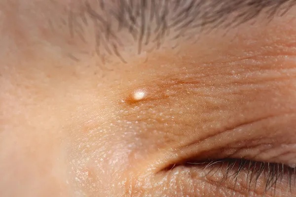 眼睛周围长得这些小颗粒,到底是什么啊啊啊啊? 眼睛周围长得这些小颗粒,到底是什么啊啊啊啊?