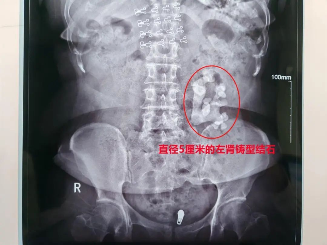 女子患肾结石不痛就掉以轻心,如今长成“生姜”填满肾脏 女子患肾结石不痛就掉以轻心,如今长成“生姜”填满肾脏