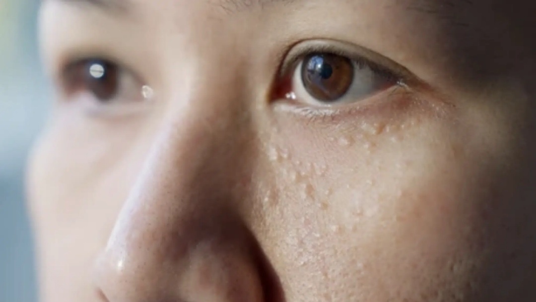 眼睛周围长得这些小颗粒,到底是什么啊啊啊啊? 眼睛周围长得这些小颗粒,到底是什么啊啊啊啊?