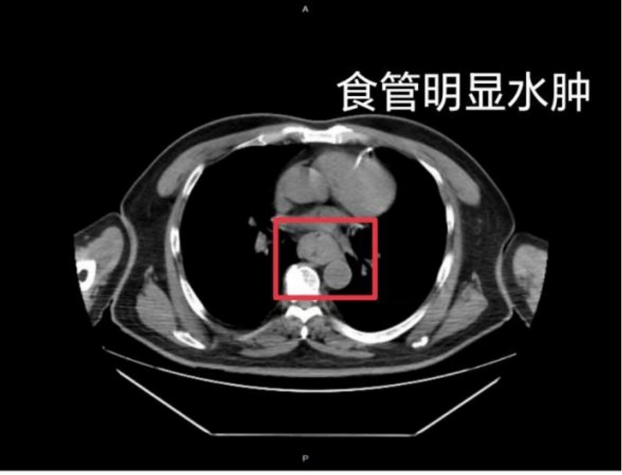 一口烫肿食管,男子吐血休克!“趁热吃”可能致癌 一口烫肿食管,男子吐血休克!“趁热吃”可能致癌