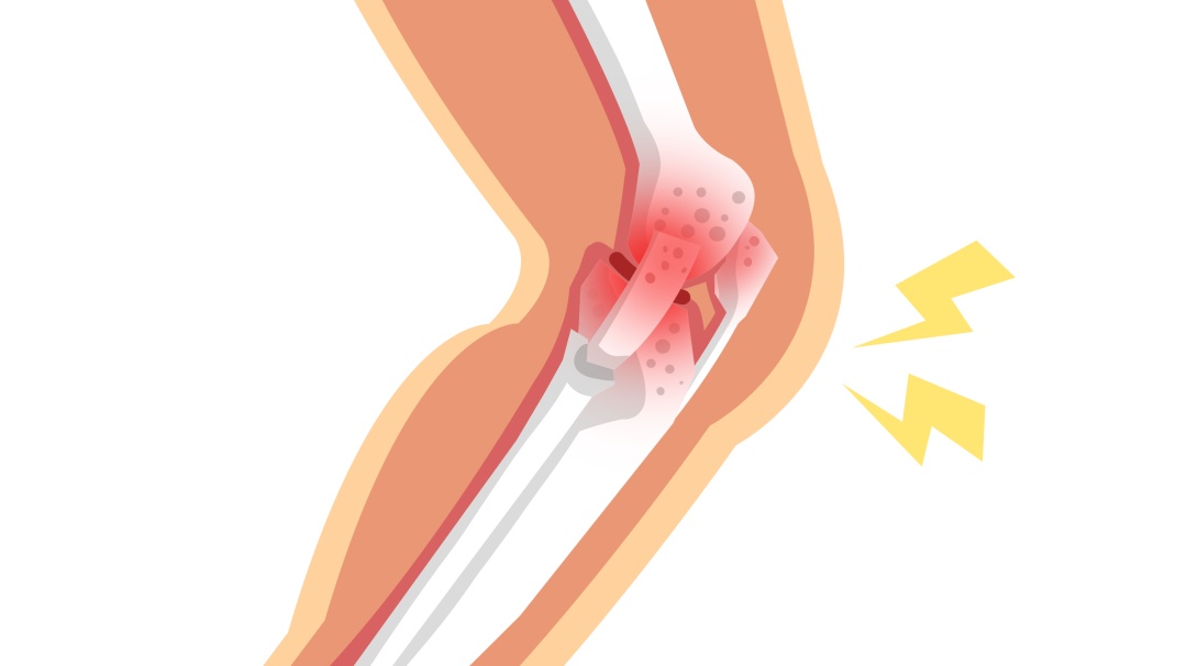 运动损伤高发季已至！肌肉拉伤？还是韧带拉伤？一文读懂！