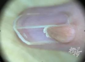 女子频繁美甲，手上竟长出这个……医生：赶紧切！