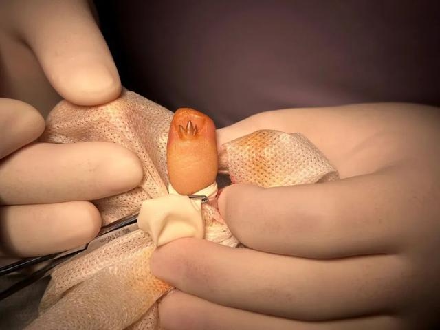 频繁做美甲，女子指甲上惊现……医生：赶紧切！