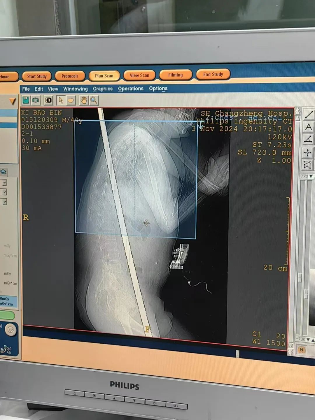 男子高坠,1.3米长钢筋贯穿整个胸腹腔,医院展开7小时生死大援救 男子高坠,1.3米长钢筋贯穿整个胸腹腔,医院展开7小时生死大援救