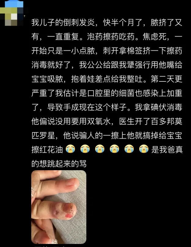 手上长“倒刺”后，这个动作很多人在做！医生提醒……