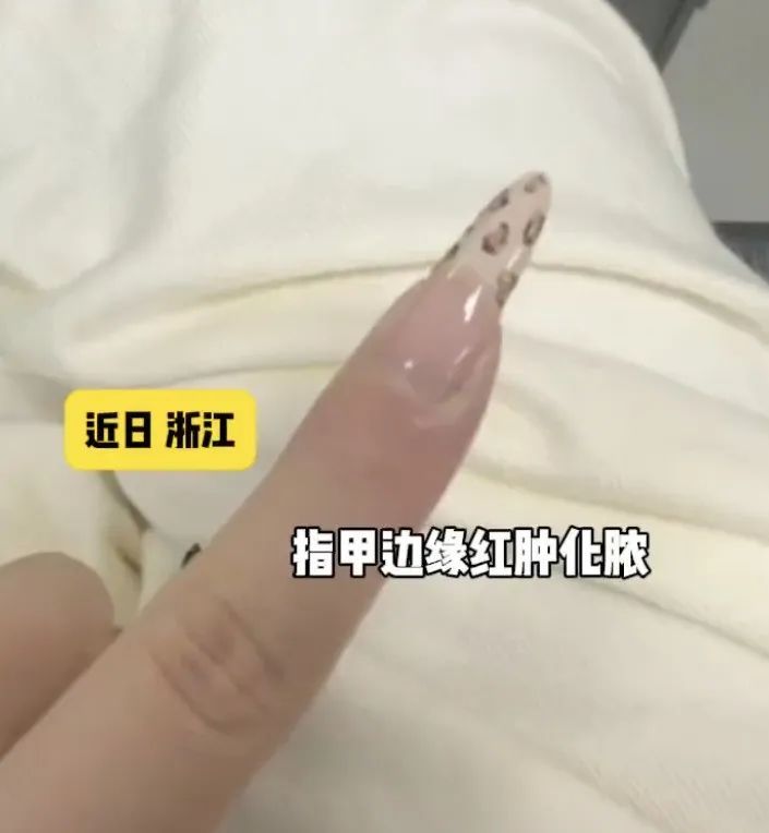 手上长“倒刺”后，这个动作很多人在做！医生提醒……