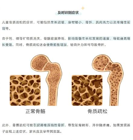 不是“老年专属”!如何预防儿童骨质疏松,答案都在这→ 不是“老年专属”!如何预防儿童骨质疏松,答案都在这→
