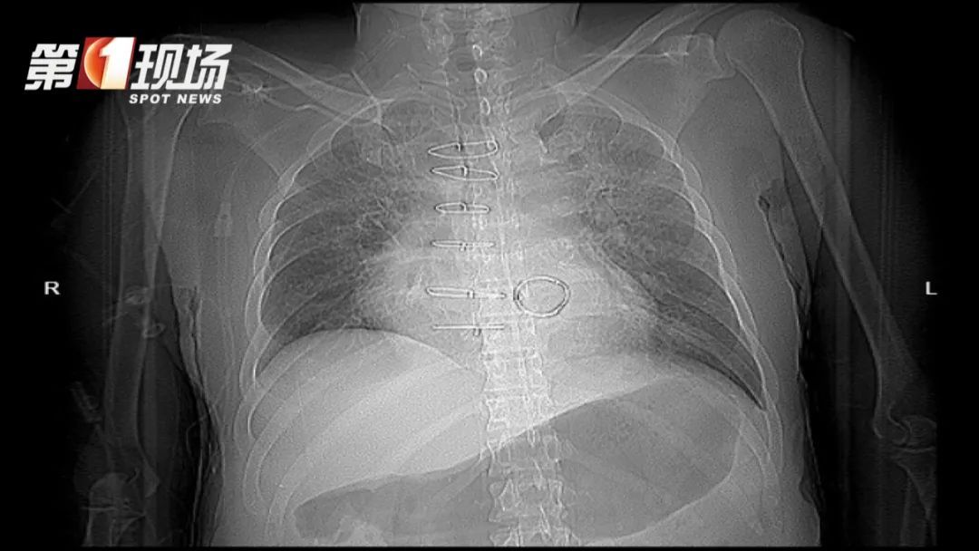 一次蛀牙，差点要了他的命！这个“小病”必须警惕…