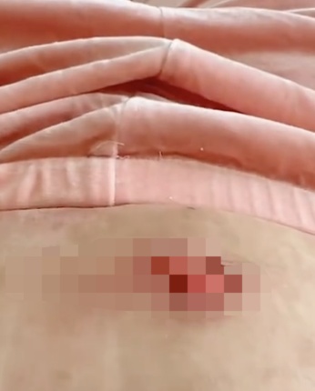 一觉醒来,女子肚皮撕掉一块!又是它惹的祸,很多人都在用…… 一觉醒来,女子肚皮撕掉一块!又是它惹的祸,很多人都在用……