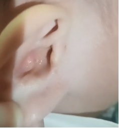 颅内感染、脑脊液从耳朵流出!一岁半娃鼓膜穿孔竟是因为…… 颅内感染、脑脊液从耳朵流出!一岁半娃鼓膜穿孔竟是因为……