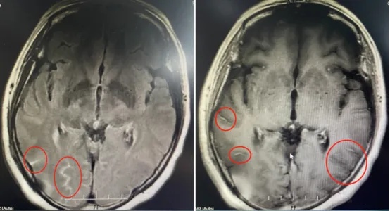 死亡率很高！51岁阿姨头疼到要“爆炸”，竟和每天买菜有关