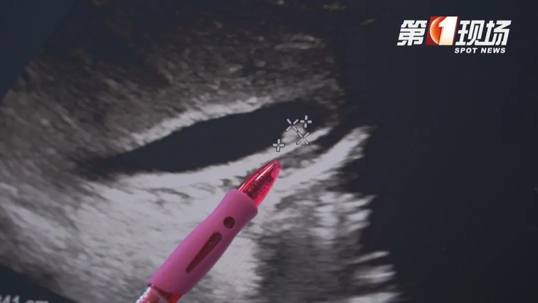 一家三口感染肝吸虫！很多广东人都爱吃这个美食……