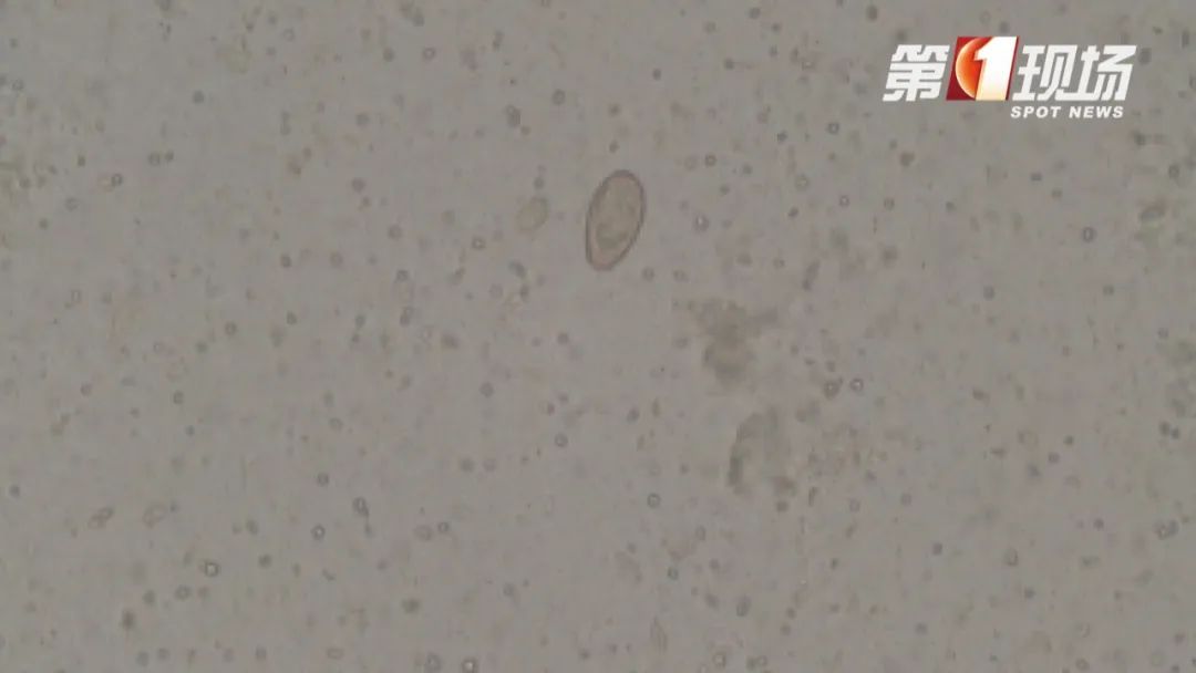 一家三口感染肝吸虫！很多广东人都爱吃这个美食……