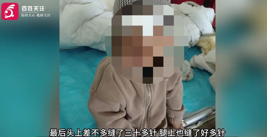 痛心！3岁男孩被烈性犬撕咬，头部缝了30多针！事发21天没找到狗主人