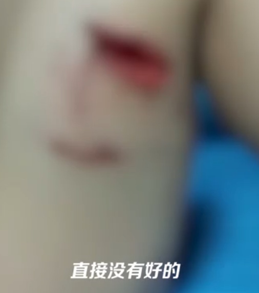 痛心！3岁男孩被烈性犬撕咬，头部缝了30多针！事发21天没找到狗主人