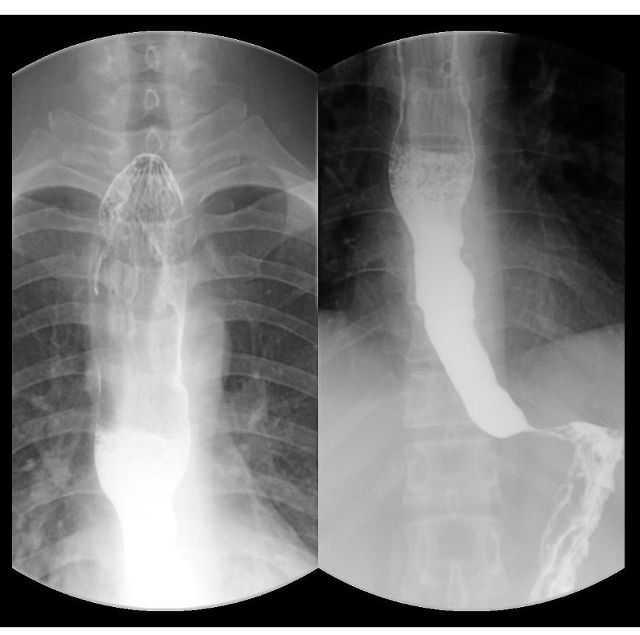 镇江一男子患上罕见病,熬了4年才找到病因! 镇江一男子患上罕见病,熬了4年才找到病因!