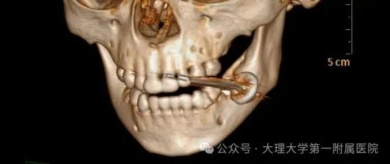 惊险！2岁孩子好奇咬电池，发生爆炸