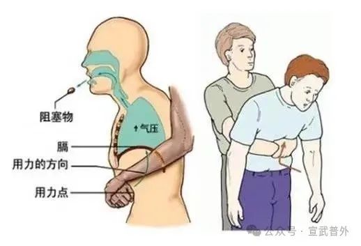 异物卡喉怎么办？