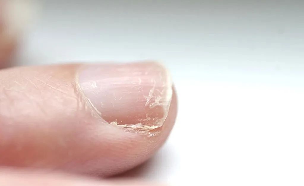 手上长倒刺，千万别直接拔！有人因此进急诊，提醒→