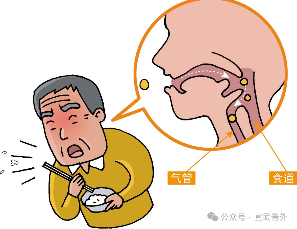 异物卡喉怎么办？