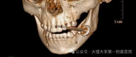 2岁幼儿咬5号电池发生爆炸,云南医生完整取出碎屑 2岁幼儿咬5号电池发生爆炸,云南医生完整取出碎屑